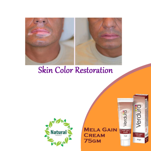 Vitiligo Treatment - Mela Gain Cream 75gm Helps Skin Colour Restoration Vitiligo - Picture 1 of 14