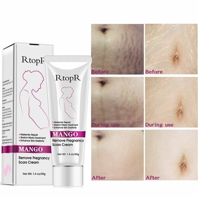 rtopr mango acne cream