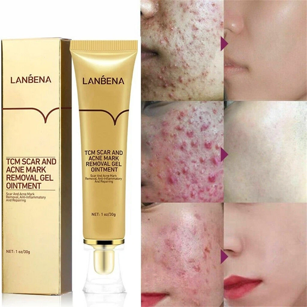 Pimple 2024 marks cream