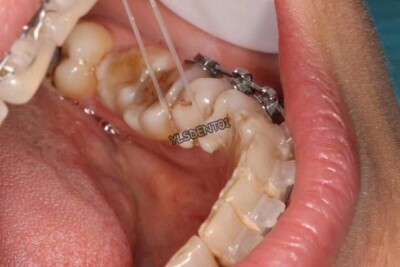 Kit De Démarrage Orthodontie Mini Injection - Brackets Lingual, Fils, Boutons, Pour Dentiste/étudiant