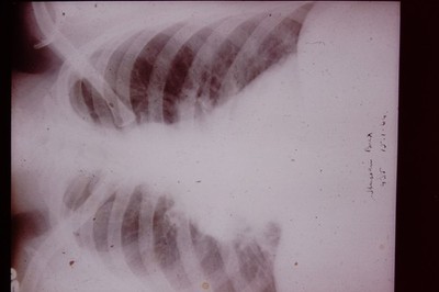 No Date Medical Slide X-Ray Mass Produced  Slide CD-K