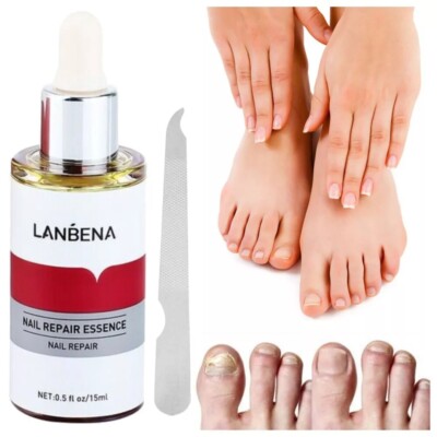 Ginger Antibacterial Fungal Nail Treatment Nail Repair Essential Oil Serum 15ml