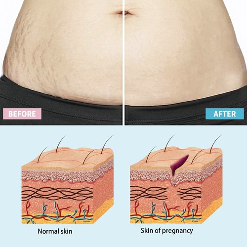 Stretchmarks Repair Cream Stretch Marks Removal Fat Stretch Mark 60g - Picture 8 of 13