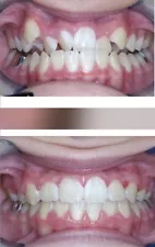 Warranty Dental Ortho Brackets 2 Sets Self Ligating MBT .022 Hooks Buccal Tube.