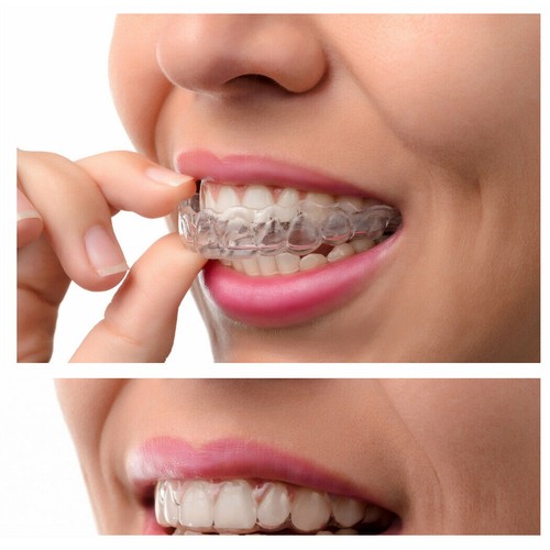 4pcs Teeth Whitening Mouth Trays Guard Thermo Gum Shield Tooth Bleaching Grind - Picture 6 of 12