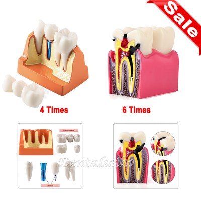 Dental Tooth Model 6Times Decay Caries Bilateral/4Times  Implant Analysis Crown
