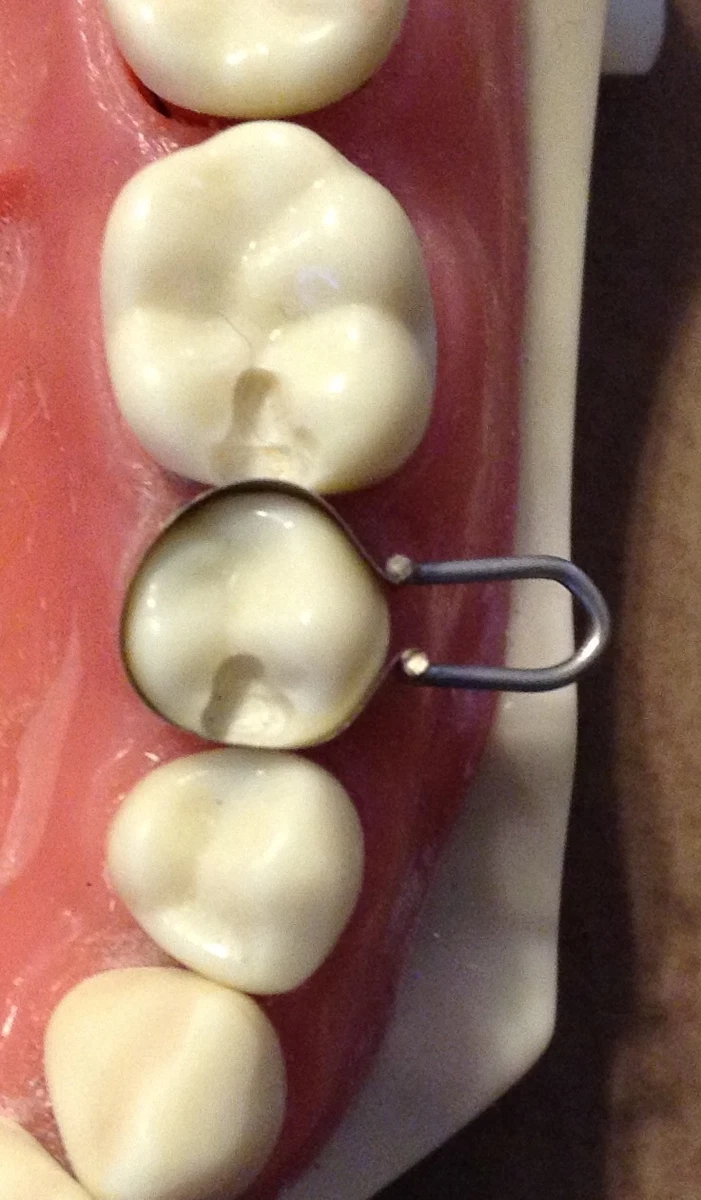Dental Matrix Bands/ The U Dental Molars The ICT University