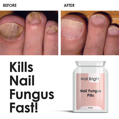 nail fungus cure pills