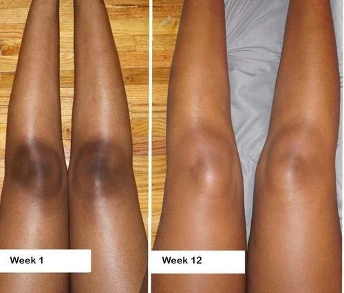 KOJIC ACID Skin Whitening Lightening Brightening Serum Bleaching/Spot Fade Cream - Image 3 of 4