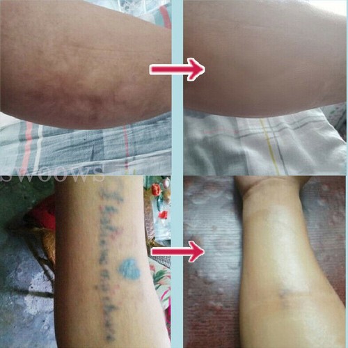 Tattoo Scar Acne-Cover Up Sticker Flaw Birthmark Concealing Hide Tape-Waterproof - Picture 10 of 22
