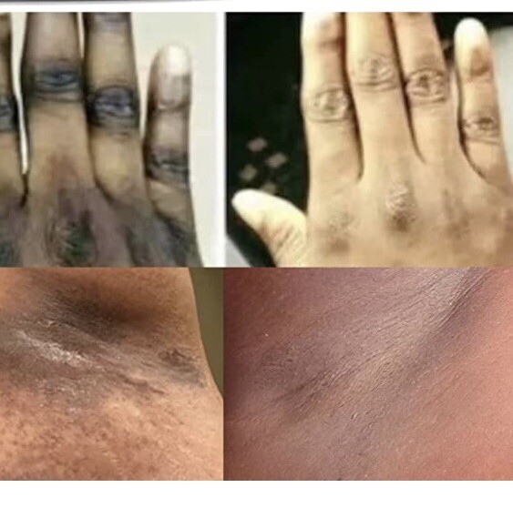 Details more than 105 body hair bleach latest POPPY