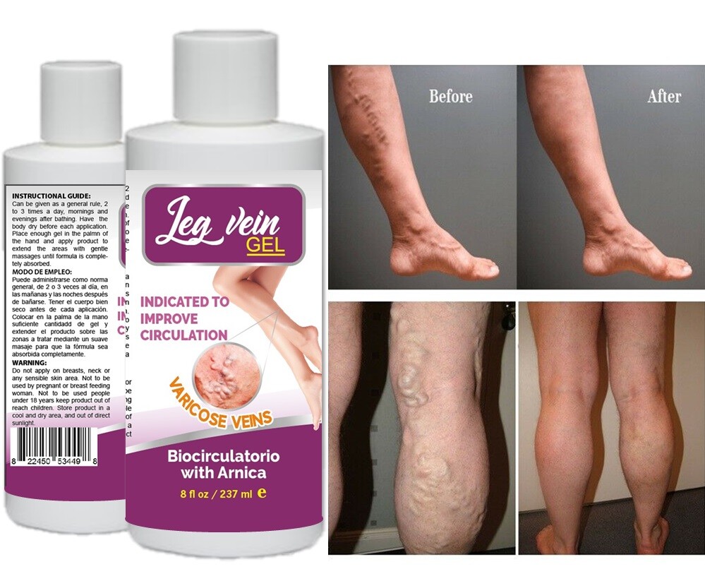 Ungüento natural venas varicosas vasculitis soporte cuidado de pies crema araña EE. UU.