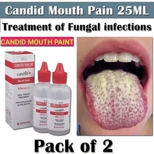 CANDID MOUTH PAINT FOR ORAL THRUSH TREATMENT FOR KILLS FUNGAL INFECTION 25ml USA