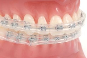 Orthodontic Comfort Cover Lip Ortho Braces Ulcer Relief Protector X 1