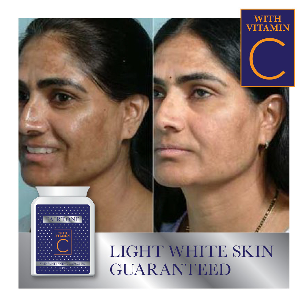 best vitamin c for melasma