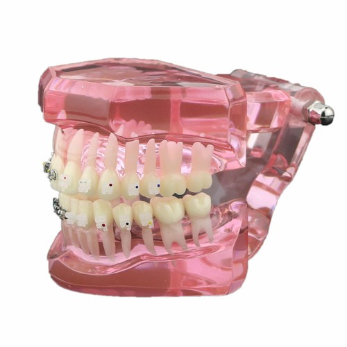 Dental Orthodontic Teeth Study Model with Metal Ceramic Bracket Braces 3003 - Picture 10 of 33