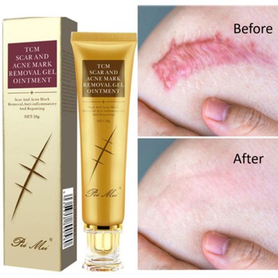 30g Acne Scar Removal Cream Pimples Stretch Marks Face Remove New~ H4U6 Gel A4U1