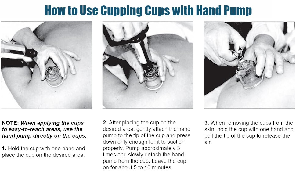 KS AcuZone Premium Plastic Cupping Set Includes 19 Cups with Extension Tube