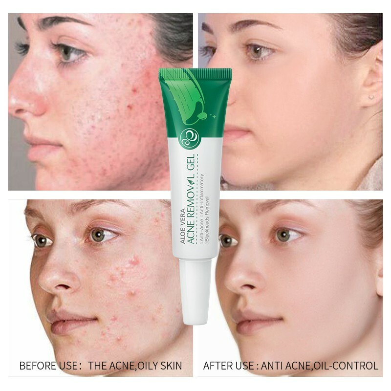 aloe vera gel as moisturizer for oily skin