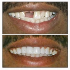 Tooth Fairy RenewaSmile Temporary Tooth Replacement Kit –Make 25 Teeth Fast Safe