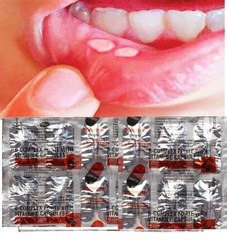 BECOSULES CAPSULES BICASULE Vitamin B-complex Help For Sore Tongue And Mouth - Picture 1 of 6