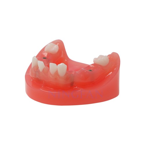 Modelo de implante dental, mandíbula superior inferior, dentaduras RPD, tipos de restauración de sobredentaduras - Imagen 104 de 154