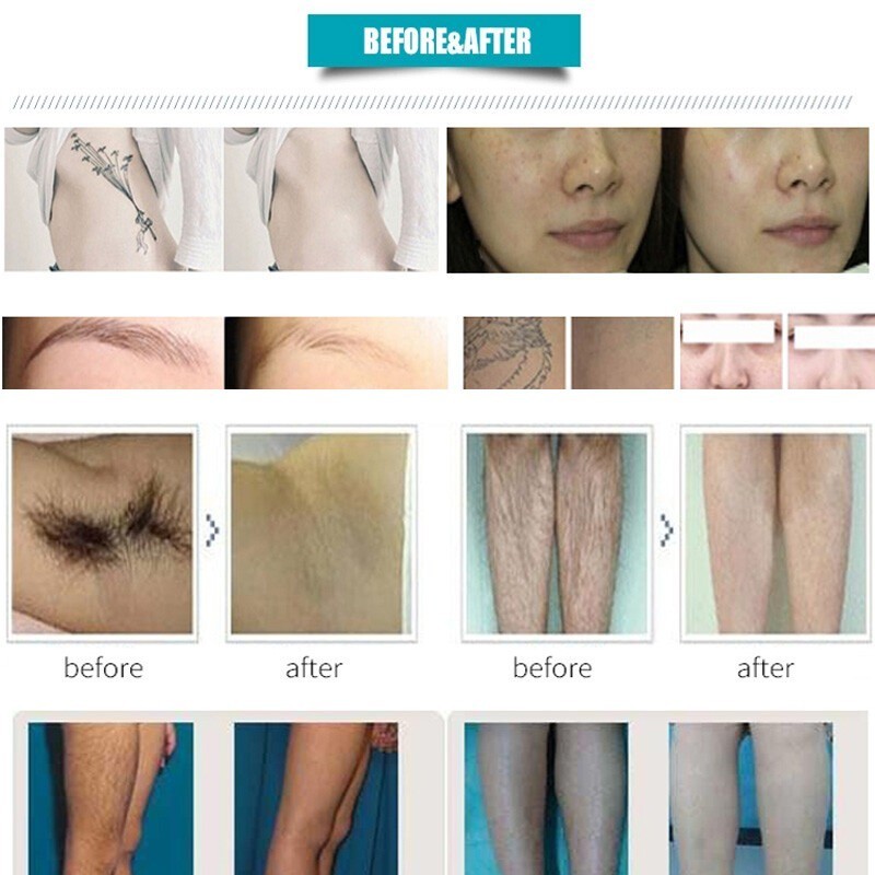 2 in 1 808nm Diode Laser Hair Removal Laser & Pico Nd: Yag Laser Tattoo Removal