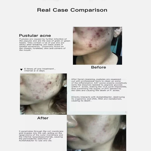 Ozone Plasma Pen Face Skin Care Anti Wrinkle Freckles Removal Acne Treatment US - Picture 6 of 9