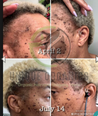 Alopecia Gel 4パック Alopecia Hair Growth Cream – 4 oz Nourishing Formula for Thicker