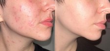 CLINIQUE Acne Solutions Clinical Clearing Gel Acne Medication 1oz/30mL Brand New