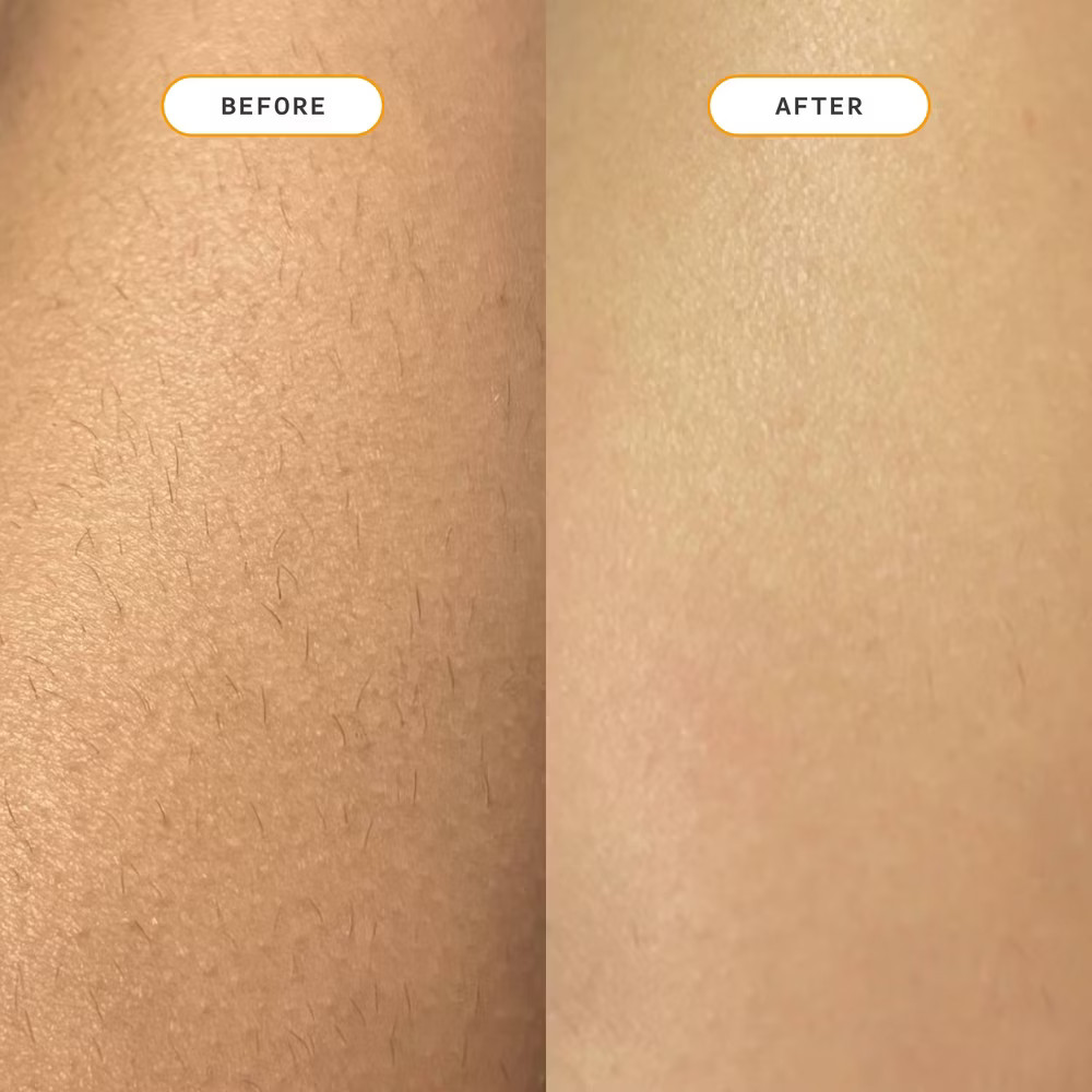 Nood Ingrown Hair Treatment - The Eraser