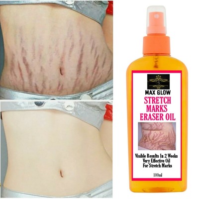 alpha arbutin stretch marks