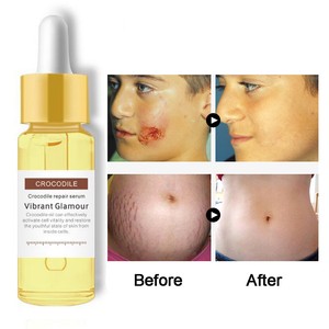 serums for acne scars