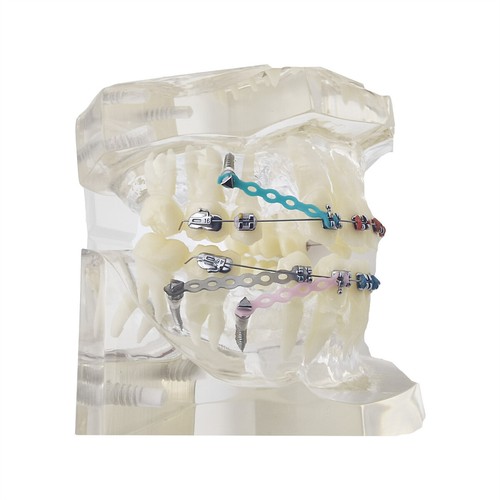 Multiple Types Dental Teeth Model Ortho Implant Practice Teaching Demo Model - Picture 215 of 276
