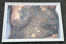 Survivor Body Reconstruction Art – Framed Abstract Medical Breast Cancer Series