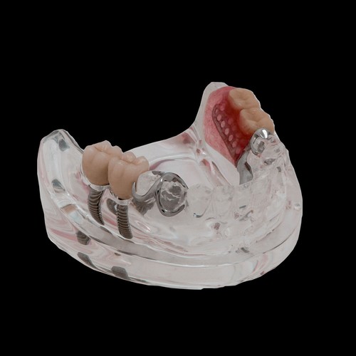 Modelo de reparación de implantes dentales prótesis parciales removibles modelo Typodont transparente - Imagen 4 de 13