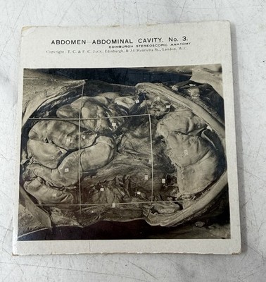 Antique Medical Stereoview Anatomy Card Abdominal Cavity Edinburgh