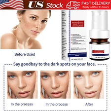 Effective Whitening Freckle Cream Remove Dark Spot Cream Removal Melanin Melasma
