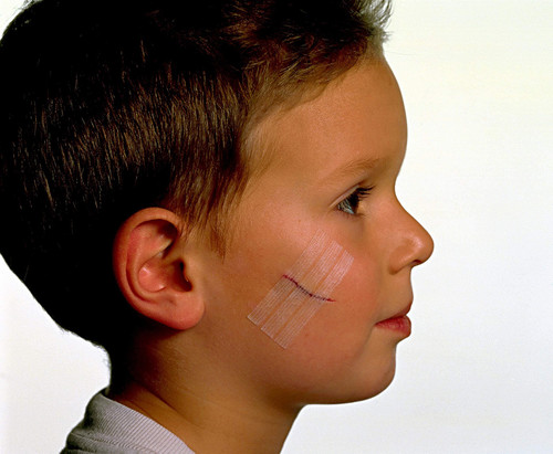 Steri-Strip Wound Closure, Breathable Strips Hold Small Wounds Firmly Closed,... - Picture 6 of 6