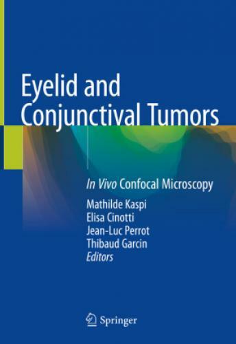 Thumbnail - Eyelid And Conjunctival Tumors In Vivo Confocal Microscopy 5855