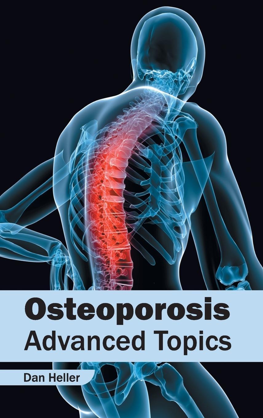 Thumbnail - Dan Heller | Osteoporosis | Buch | Englisch (2015) | Advanced Topics