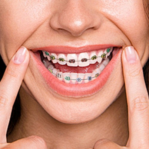 NEWFake Braces Kids Fake Braces Lip Protector Colorful Braces Wire Teeth Cosplay - Picture 4 of 8