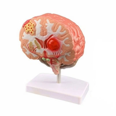 Cerveau Anatomique Modèle de Cerveau Pathologique Médical pour Enseignants - Photo 1/4