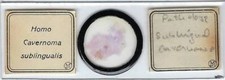 Human Sublingual Cavernoma Pathology Microscope Slide by Moeller