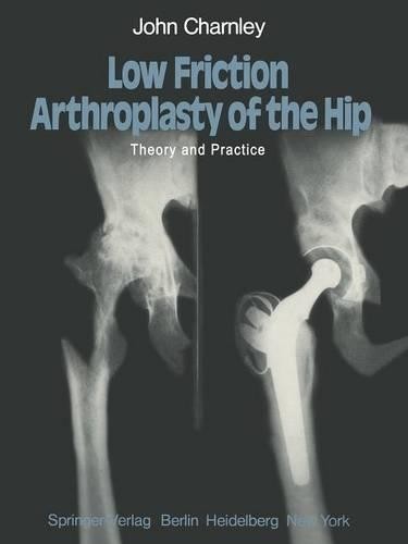 Low Friction Arthroplasty of the Hip by J. Charnley - 9783642670152