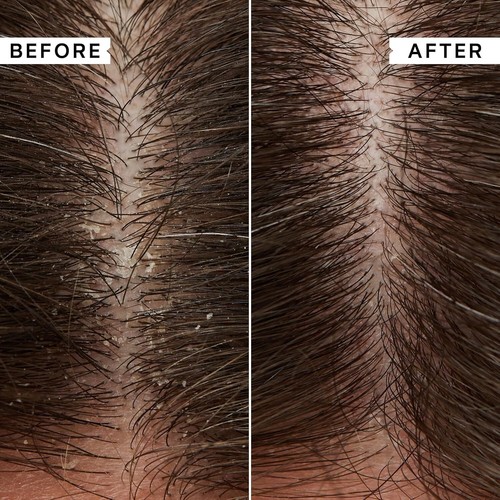 2 X Philip Kingsley Flaky/Itchy Scalp Anti-Dandruff Shampoo 75ml - 第 2/4 張圖片