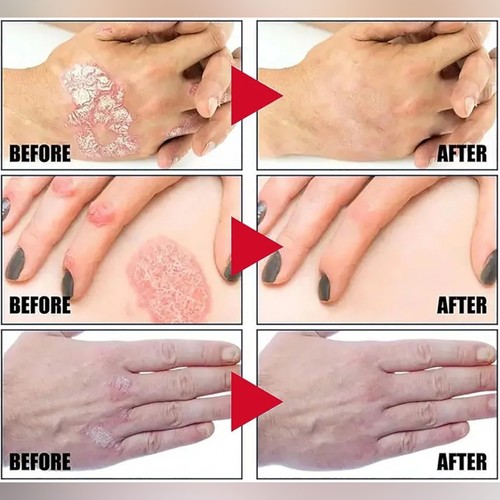 2 Stück TODAHOF Bienengift Psoriasis Behandlung Creme Hauterkrankungen Rosacea Ance - Bild 9 von 16