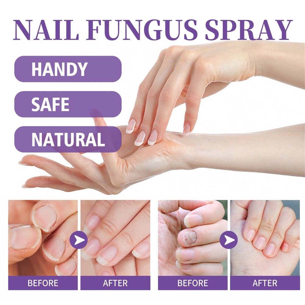 3X Medinail Fungus Spray 100ml,Toenail Fungus Treatment,Nail Fungus