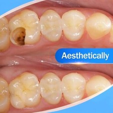 Tooth Repair Resin Dental Cement for Cavity Filling Strong Restoration Kit