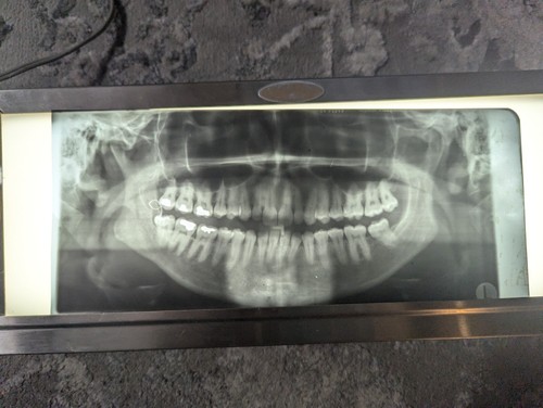 15 Dental Panoramic X-ray Films, Vintage Curiosities